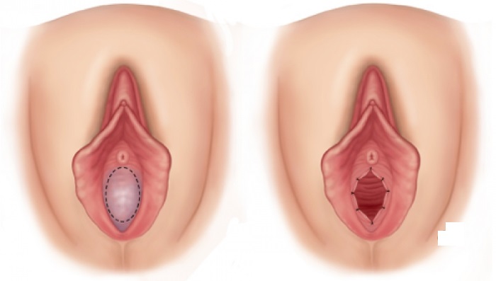 Hymenoplasty - what is it, before and after photos, stages of the operation, results, rehabilitation and possible complications