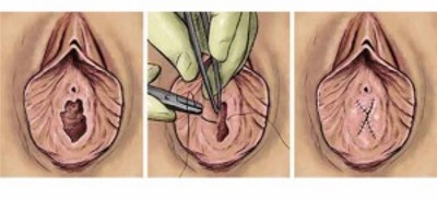 Hymenoplasty - what is it, before and after photos, stages of the operation, results, rehabilitation and possible complications