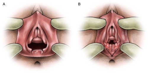 Hymenoplasty - what is it, before and after photos, stages of the operation, results, rehabilitation and possible complications