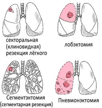 How ribs are removed, why. Operation to remove the lower ribs, thin waist for women, men, price, photo