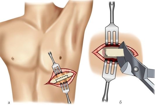 How ribs are removed, why.Operation to remove the lower ribs, thin waist for women, men, price, photo