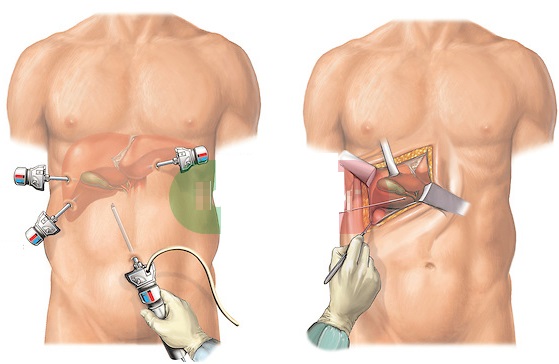 How ribs are removed, why. Operation to remove the lower ribs, thin waist for women, men, price, photo