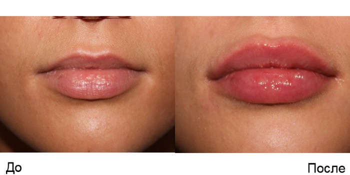 Lip contouring - a technique of augmentation with hyaluronic acid, fillers. Photos and prices