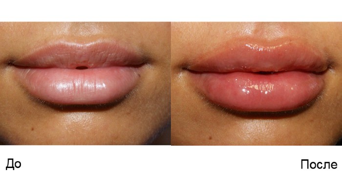 Lip contouring - a technique of augmentation with hyaluronic acid, fillers. Photos and prices