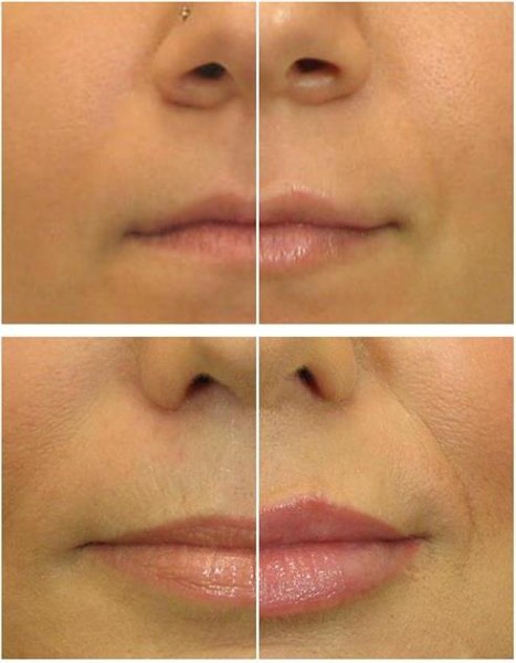 Lip contouring - a technique of augmentation with hyaluronic acid, fillers. Photos and prices