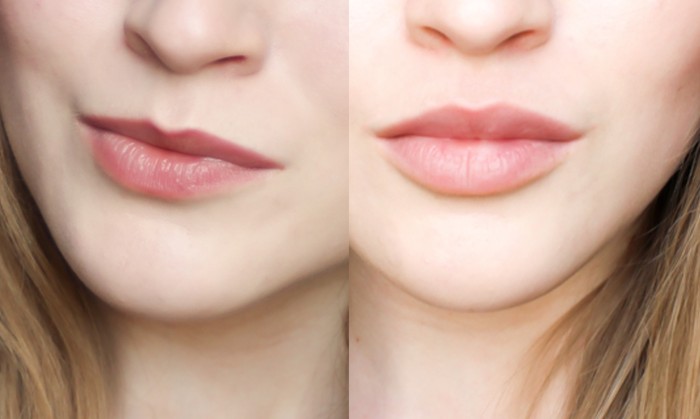 Lip contouring - a technique of augmentation with hyaluronic acid, fillers. Photos and prices