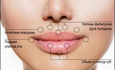 Lip contouring - a technique of augmentation with hyaluronic acid, fillers. Photos and prices