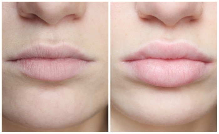 Lip contouring - a technique of augmentation with hyaluronic acid, fillers. Photos and prices