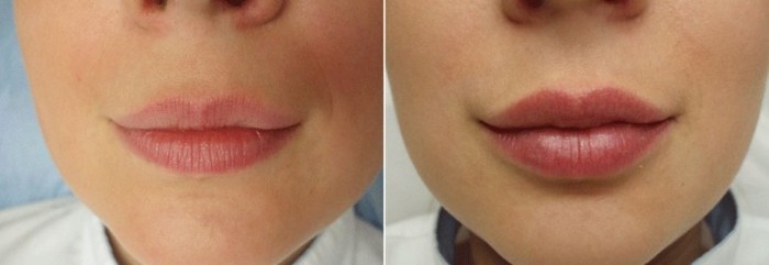 Lip contouring - a technique of augmentation with hyaluronic acid, fillers. Photos and prices