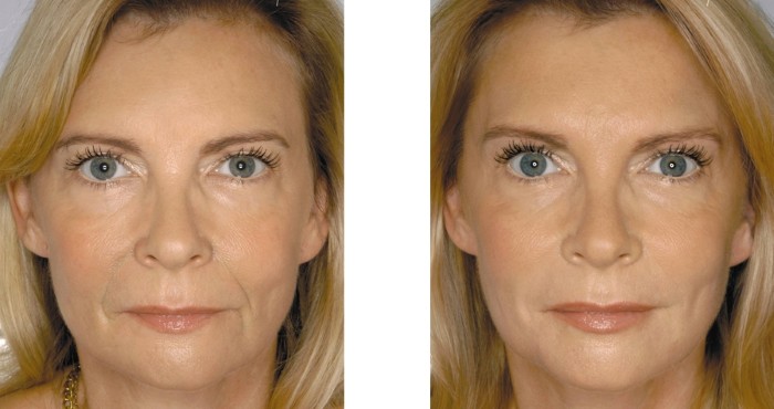 Lip contouring - a technique of augmentation with hyaluronic acid, fillers. Photos and prices