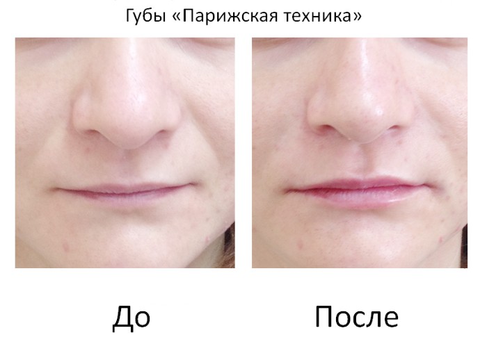 Lip contouring - a technique of augmentation with hyaluronic acid, fillers. Photos and prices