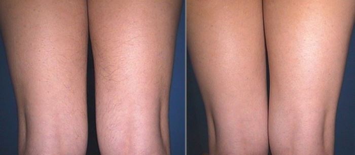 Laser hair removal for face and body. Reviews, photos before and after, contraindications and consequences