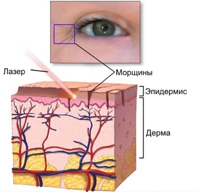 Laser resurfacing of facial skin from scars and scars. Photos before and after, price, reviews. Home skin care after the procedure