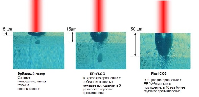 Laser resurfacing of facial skin from scars and scars. Photos before and after, price, reviews. Home skin care after the procedure