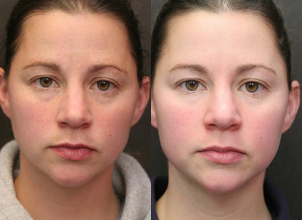 Laser resurfacing of facial skin from scars and scars. Photos before and after, price, reviews. Home skin care after the procedure