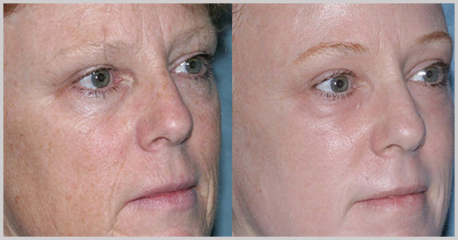 Laser resurfacing of facial skin from scars and scars. Photos before and after, price, reviews. Home skin care after the procedure