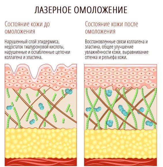 Laser resurfacing of facial skin from scars and scars. Photos before and after, price, reviews. Home skin care after the procedure