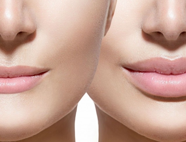 Lip augmentation with hyaluronic acid. Photos before and after the procedure, reviews. How much do injections cost