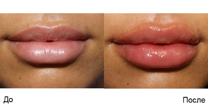 Lip augmentation with hyaluronic acid. Photos before and after the procedure, reviews. How much do injections cost