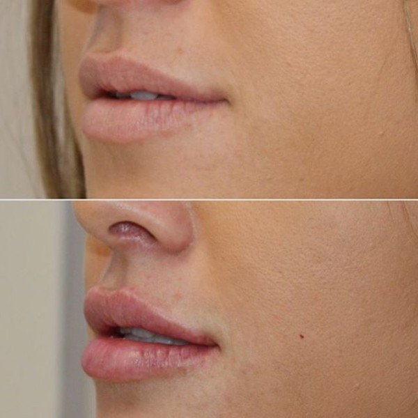 Lip augmentation with hyaluronic acid. Photos before and after the procedure, reviews. How much do injections cost