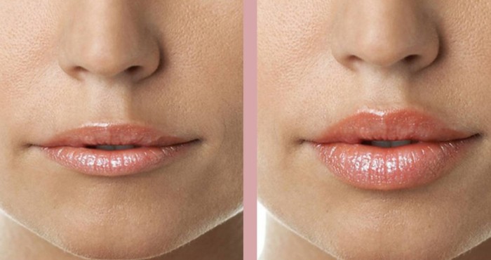 Lip augmentation with hyaluronic acid. Photos before and after the procedure, reviews. How much do injections cost