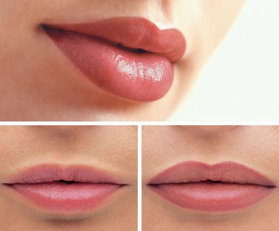 Lip augmentation with hyaluronic acid. Photos before and after the procedure, reviews. How much do injections cost