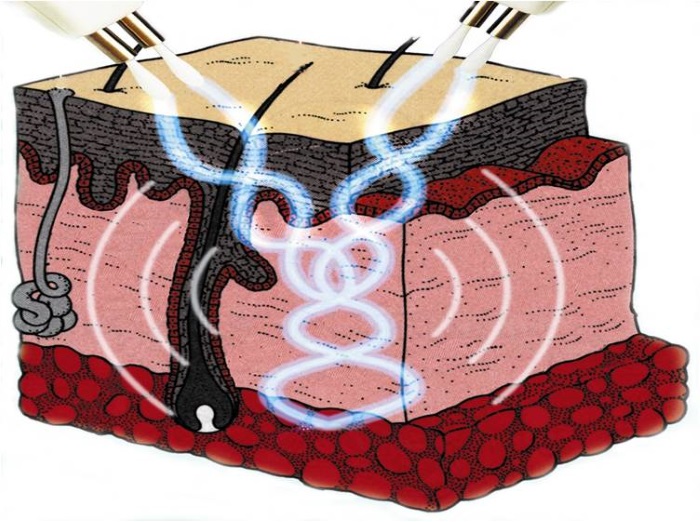 Mikroströme für das Gesicht in der Kosmetologie - ein Gerätetherapieverfahren. Preis, Bewertungen