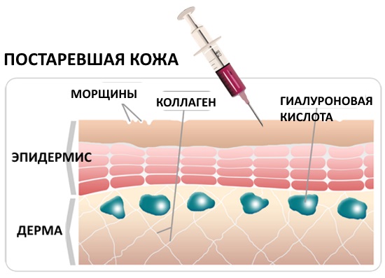 Plasma therapy - plasmolifting of the skin of the face and neck, indications, contraindications, photos, price of the procedure, reviews