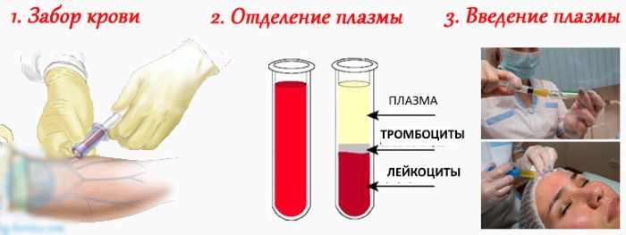 Plasma therapy - plasmolifting of the skin of the face and neck, indications, contraindications, photos, price of the procedure, reviews