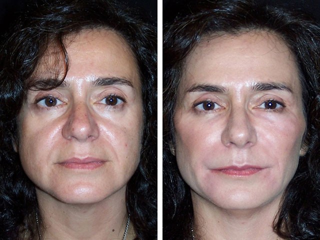 Radiesse - filler preparation for vector lifting in cosmetology