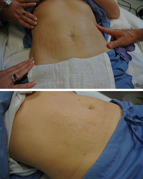 Stretch marks in pregnant women, adolescents on the body, stomach, chest, legs, buttocks, back. Reasons how to remove