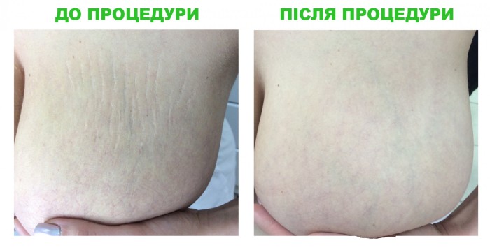 Stretch marks in pregnant women, adolescents on the body, stomach, chest, legs, buttocks, back. Reasons how to remove