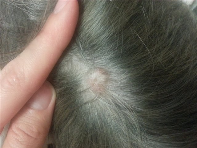 Laser removal of moles, surgical method, at home. Consequences, how long the wound heals, scars