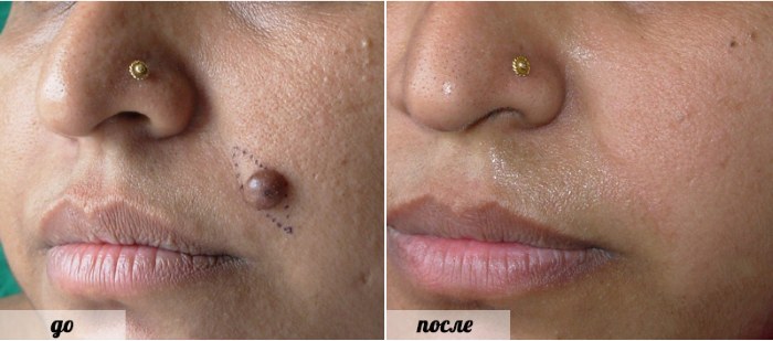 Laser removal of moles, surgical method, at home. Consequences, how long the wound heals, scars