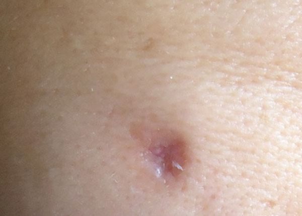 Laser removal of moles, surgical method, at home. Consequences, how long the wound heals, scars