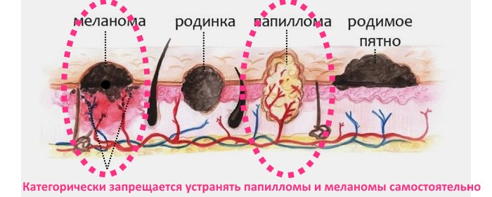 Laser removal of moles, surgical method, at home. Consequences, how long the wound heals, scars