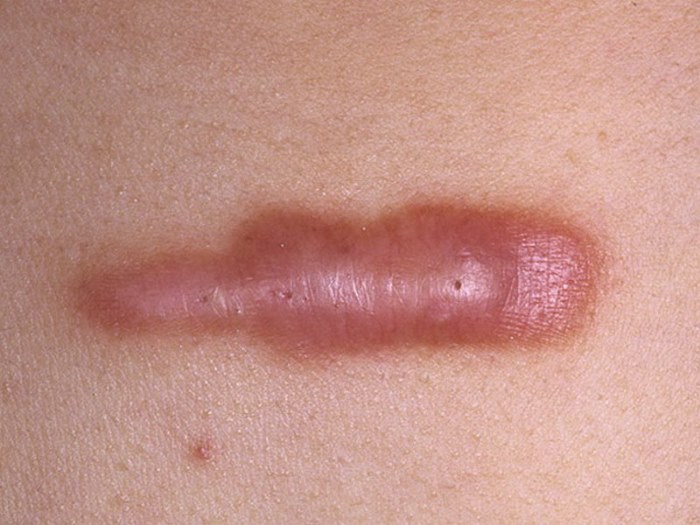 Laser removal of moles, surgical method, at home. Consequences, how long the wound heals, scars