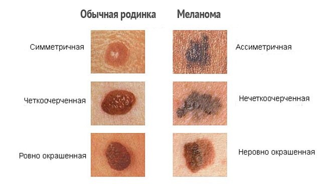 Laser removal of moles, surgical method, at home. Consequences, how long the wound heals, scars