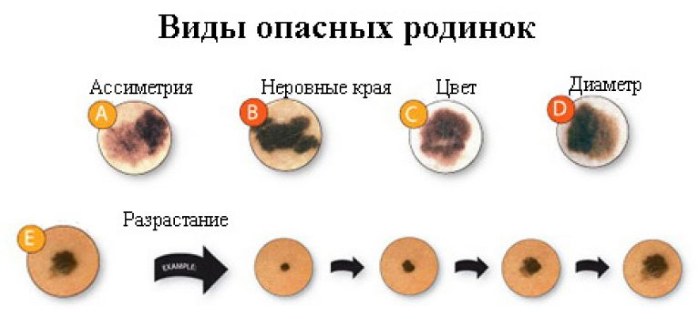 Laser removal of moles, surgical method, at home. Consequences, how long the wound heals, scars