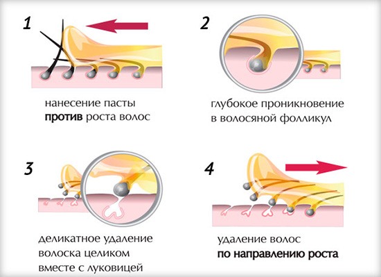 How to get rid of facial hair in women - products and procedures, remove with thread, cream, laser