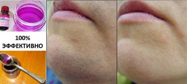 How to get rid of facial hair in women - products and procedures, remove with thread, cream, laser