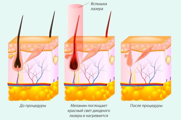 How to get rid of facial hair in women - products and procedures, remove with thread, cream, laser