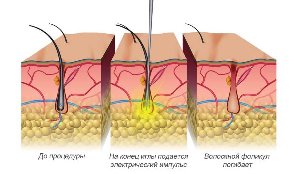 How to get rid of facial hair in women - products and procedures, remove with thread, cream, laser