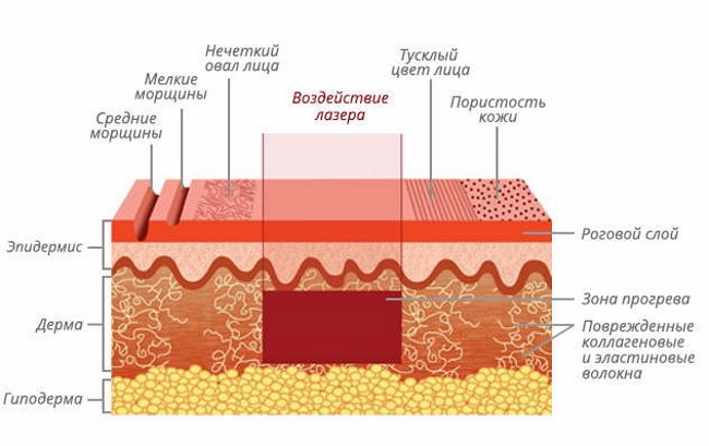 Fractional rejuvenation - what is it, the pros and cons for facial skin, reviews