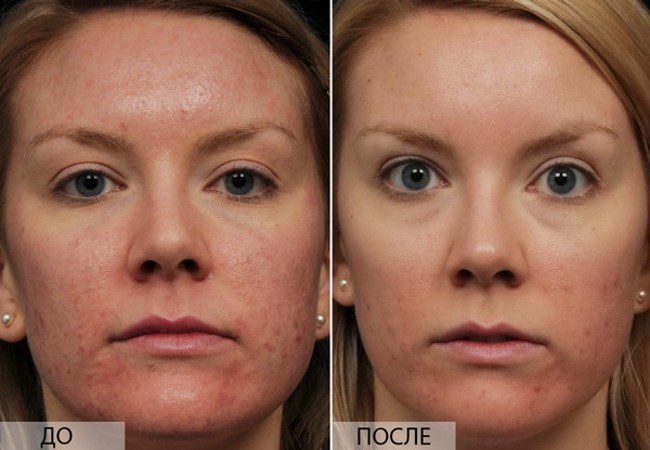 Fractional rejuvenation - what is it, the pros and cons for facial skin, reviews