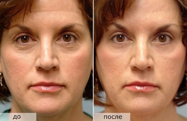 Fractional rejuvenation - what is it, the pros and cons for facial skin, reviews