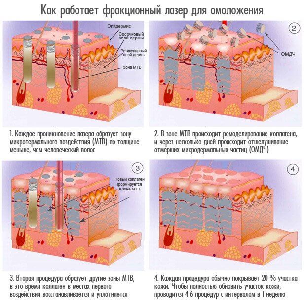 Fractional rejuvenation - what is it, the pros and cons for facial skin, reviews