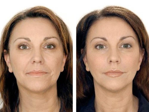 What is botox for the face, injections, injections of nano botox in the forehead, nasolabial folds, armpits