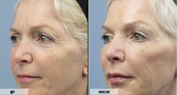 What is botox for the face, injections, injections of nano botox in the forehead, nasolabial folds, armpits