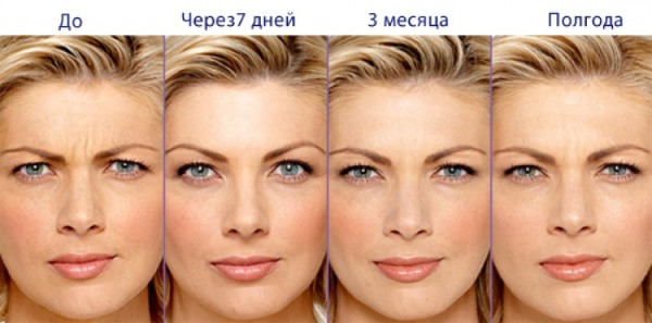 What is botox for the face, injections, injections of nano botox in the forehead, nasolabial folds, armpits